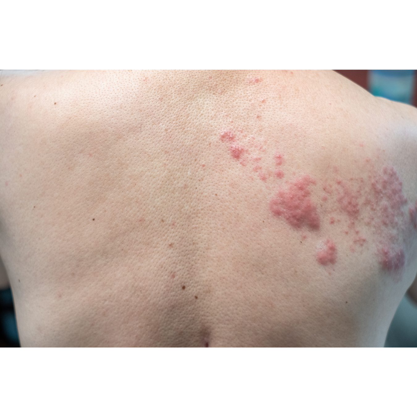 understanding shingles